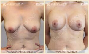 Dr Eddy Dona - Breast Lift and Implants Surgery - Before and After