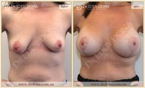 Dr Eddy Dona - Breast Lift and Implants Surgery - Before and After