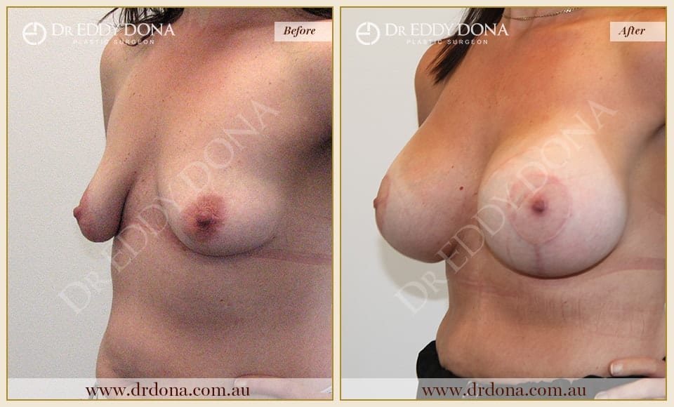 Dr Eddy Dona - Breast Lift and Implants Surgery - Before and After