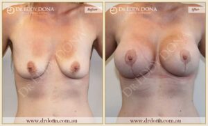 Dr Eddy Dona - Breast Lift and Implants Surgery - Before and After