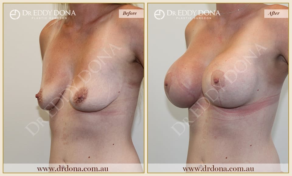 Dr Eddy Dona - Breast Lift and Implants Surgery - Before and After