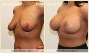 Dr Eddy Dona - Breast Lift and Implants Surgery - Before and After