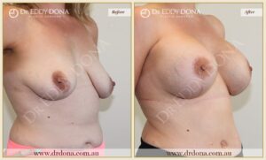 Dr Eddy Dona - Breast Lift and Implants Surgery - Before and After