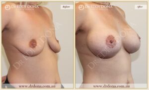 Dr Eddy Dona - Breast Lift and Implants Surgery - Before and After