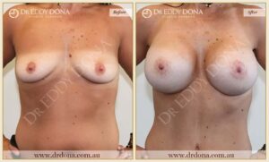 Dr Eddy Dona - Breast Lift and Implants Surgery - Before and After