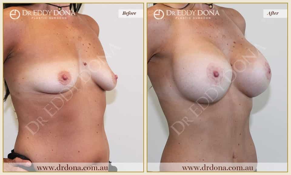 Dr Eddy Dona - Breast Lift and Implants Surgery - Before and After