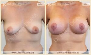 Dr Eddy Dona - Breast Lift and Implants Surgery - Before and After