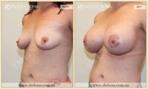 Dr Eddy Dona - Breast Lift and Implants Surgery - Before and After