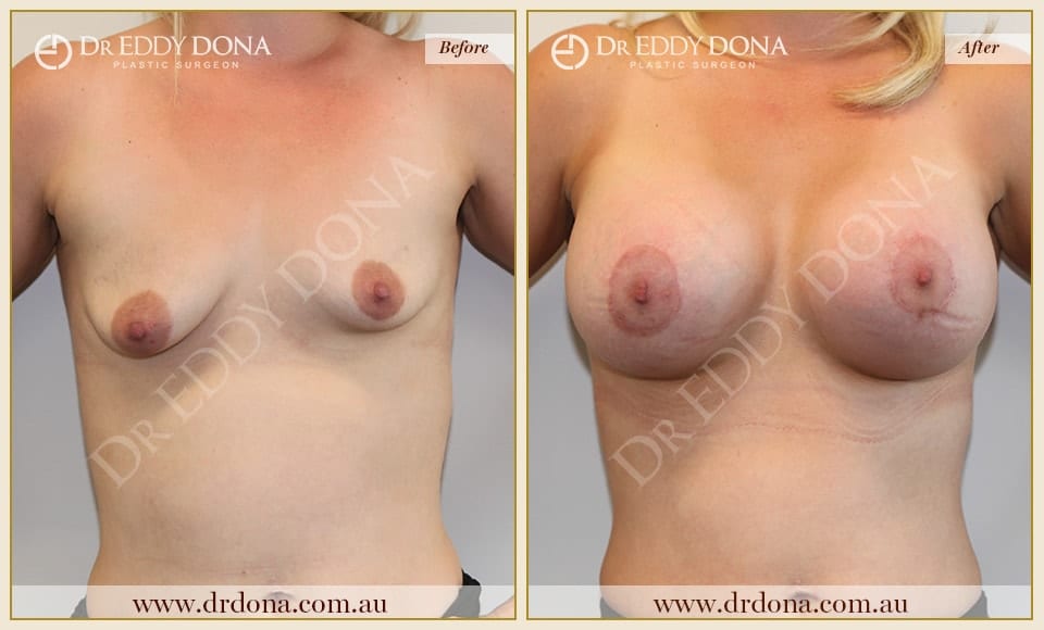 Dr Eddy Dona - Breast Lift and Implants Surgery - Before and After