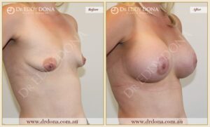 Dr Eddy Dona - Breast Lift and Implants Surgery - Before and After