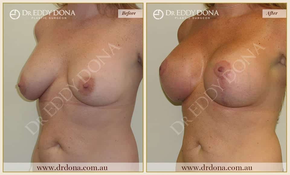 Dr Eddy Dona - Breast Lift and Implants Surgery - Before and After