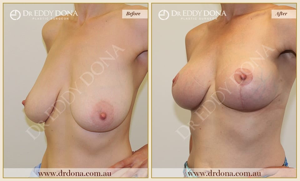 Dr Eddy Dona - Breast lift Surgery - Before and After