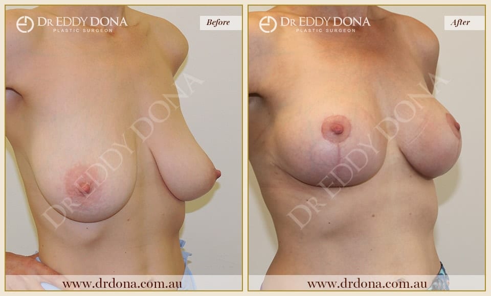 Dr Eddy Dona - Breast lift Surgery - Before and After