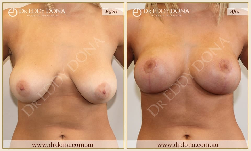 Dr Eddy Dona - Breast Lift Surgery - Before and After