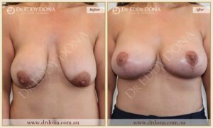 Dr Eddy Dona - Breast Lift and Implants Surgery - Before and After