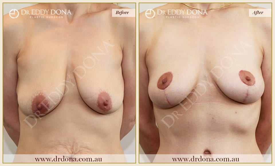 Dr Eddy Dona - Breast lift Surgery - Before and After