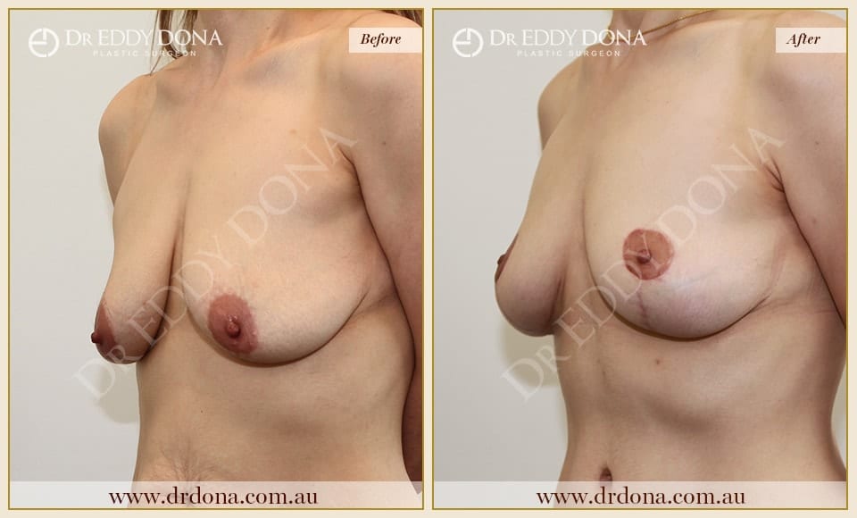 Dr Eddy Dona - Breast lift Surgery - Before and After