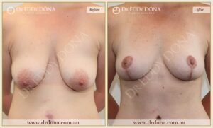 Dr Eddy Dona - Breast lift Surgery - Before and After