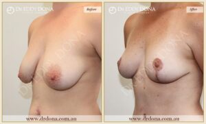 Dr Eddy Dona - Breast lift Surgery - Before and After