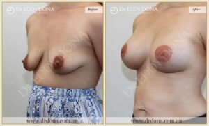 Dr Eddy Dona - Breast Lift and Implants Surgery - Before and After