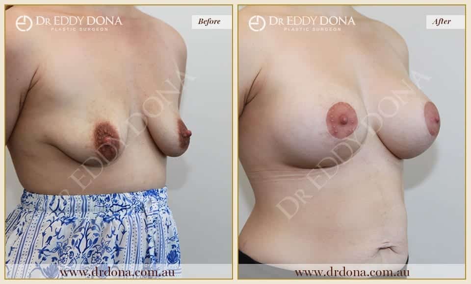 Dr Eddy Dona - Breast Lift and Implants Surgery - Before and After