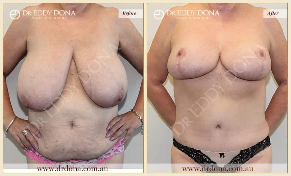 Dr Eddy Dona Before and After Mummy Makeover