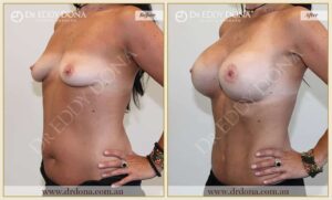 Dr Eddy Dona Before and After Mummy Makeover