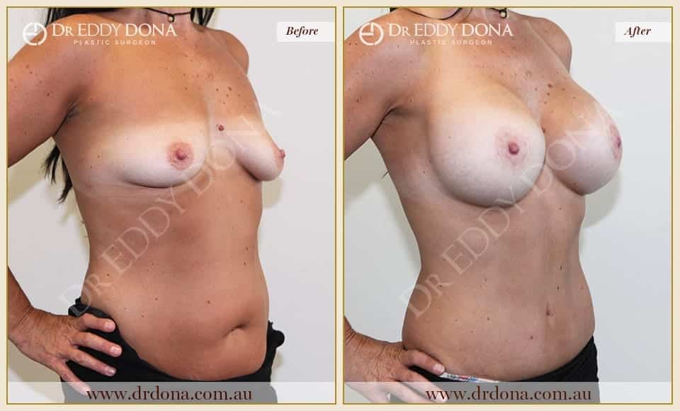 Dr Eddy Dona Before and After Mummy Makeover