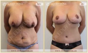 Dr Eddy Dona Before and After Mummy Makeover