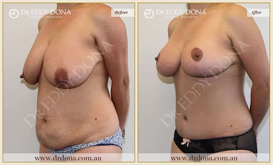 Dr Eddy Dona Before and After Mummy Makeover