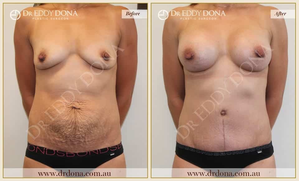 Dr Eddy Dona Before and After Mummy Makeover