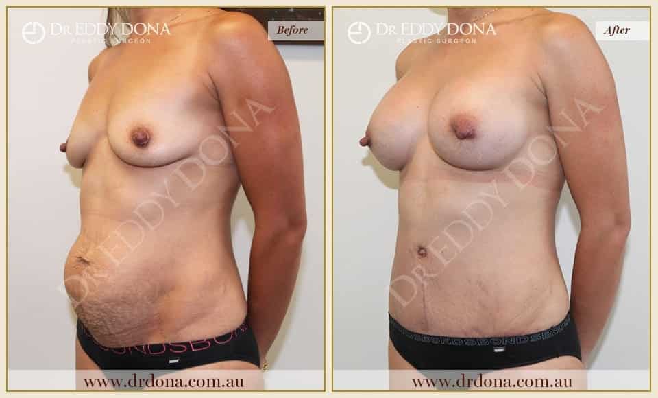 Dr Eddy Dona Before and After Mummy Makeover