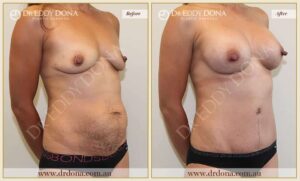 Dr Eddy Dona Before and After Mummy Makeover