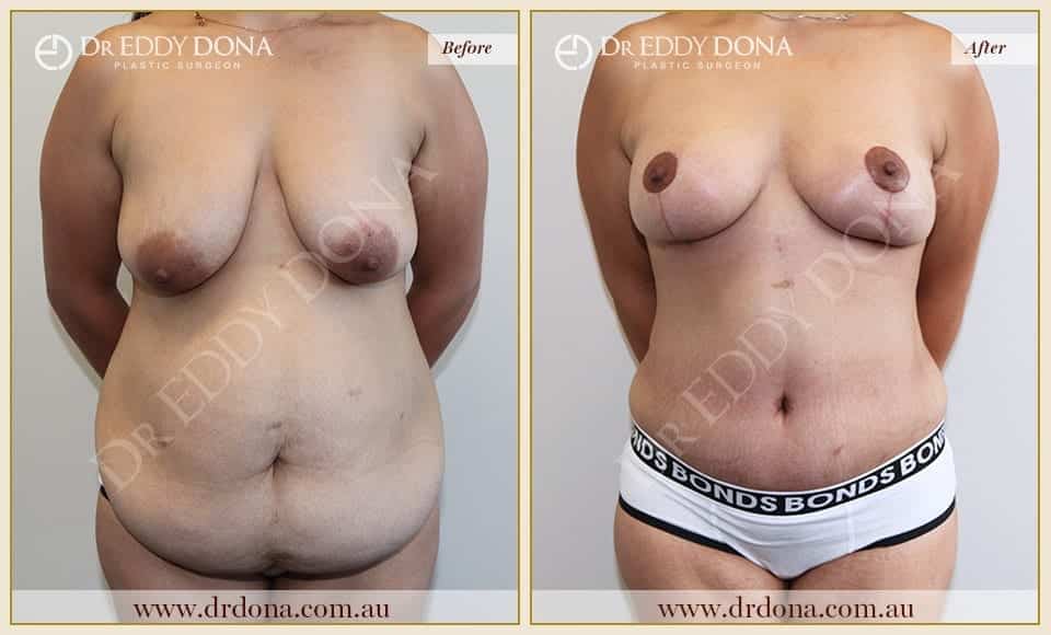 Dr Eddy Dona Before and After Mummy Makeover