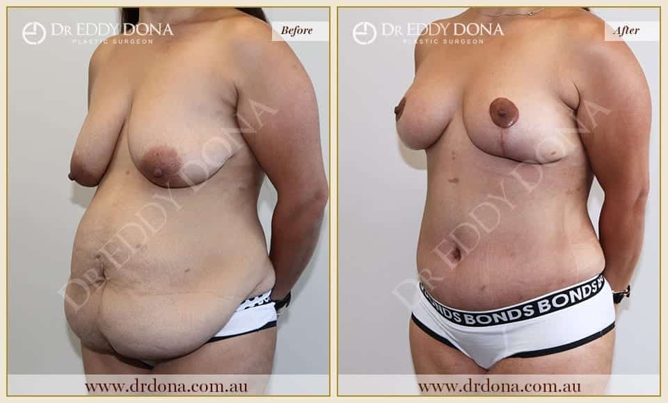 Dr Eddy Dona Before and After Mummy Makeover