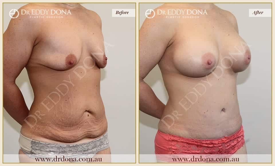 Dr Eddy Dona Before and After Mummy Makeover