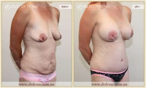 Dr Eddy Dona Before and After Mummy Makeover