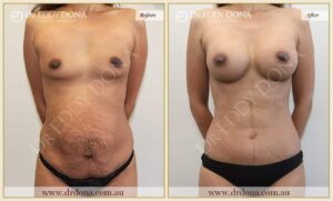 Dr Eddy Dona Before and After Mummy Makeover