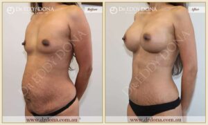 Dr Eddy Dona Before and After Mummy Makeover