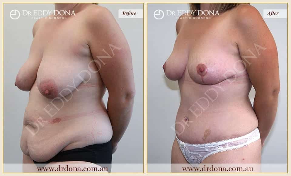 Dr Eddy Dona Before and After Mummy Makeover