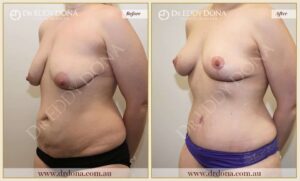 Dr Eddy Dona Before and After Mummy Makeover