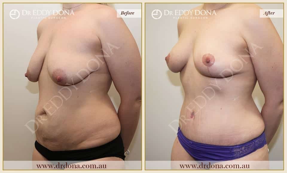 Dr Eddy Dona Before and After Mummy Makeover