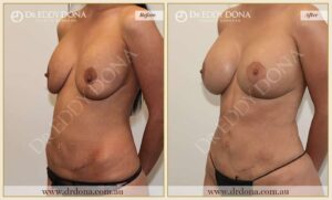 Dr Eddy Dona - Mummy Makeover - Before and After