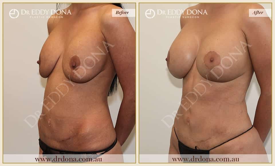 Dr Eddy Dona - Mummy Makeover - Before and After