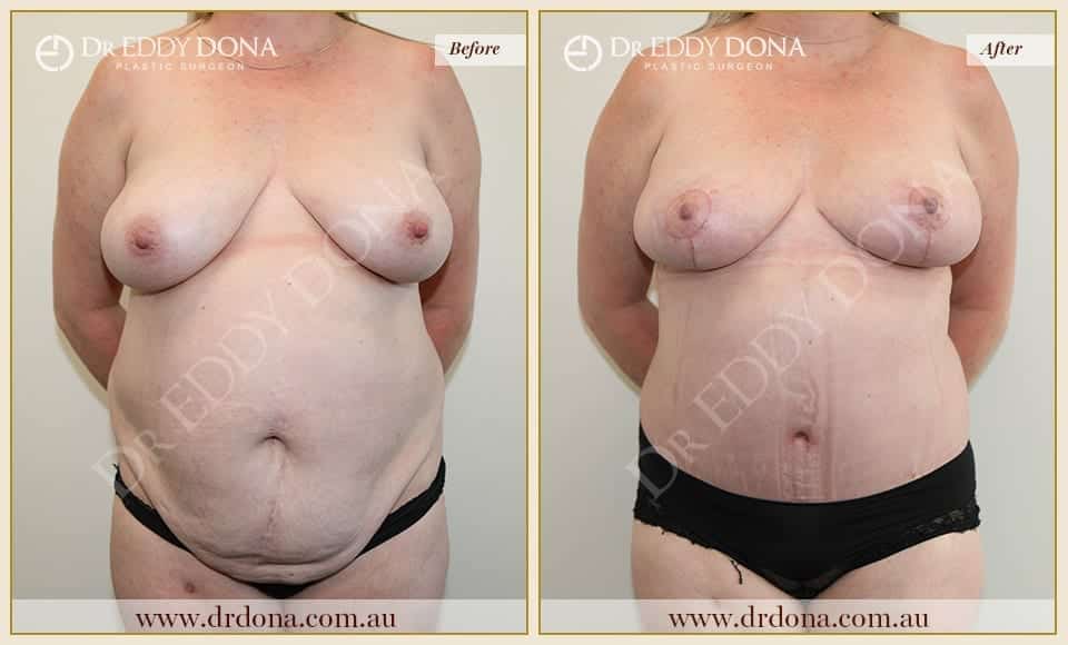 Dr Eddy Dona Before and After Mummy Makeover