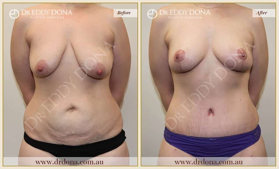 Dr Eddy Dona Before and After Mummy Makeover