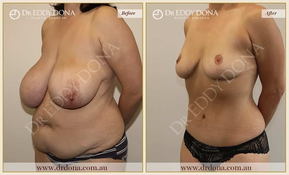 Dr Eddy Dona - Mummy Makeover - Before and After