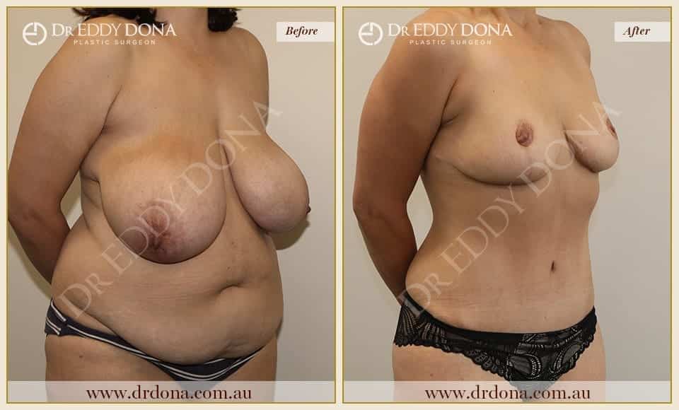 Dr Eddy Dona - Mummy Makeover - Before and After