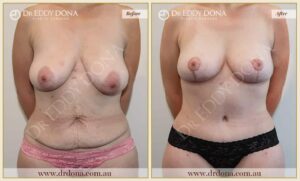 Dr Eddy Dona Mummy Makeover Before and After