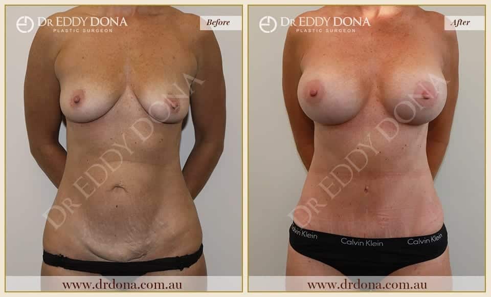 Dr Eddy Dona - Mummy Makeover - Before and After